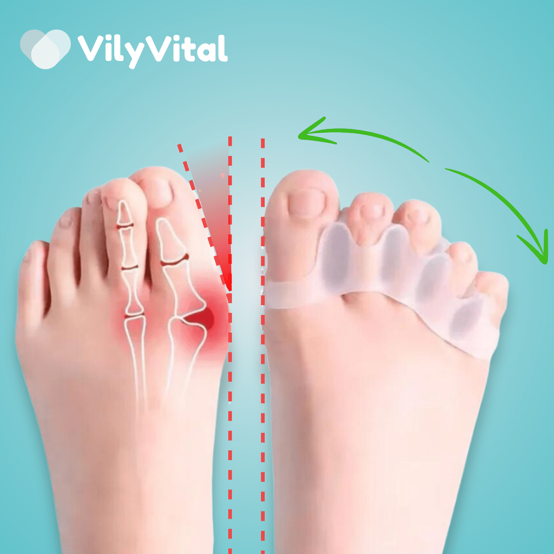 VilyVital 2Pcs Silicone Toe Separator for Correct Toe Alignment