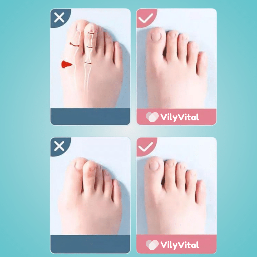 VilyVital 2Pcs Silicone Toe Separator for Correct Toe Alignment